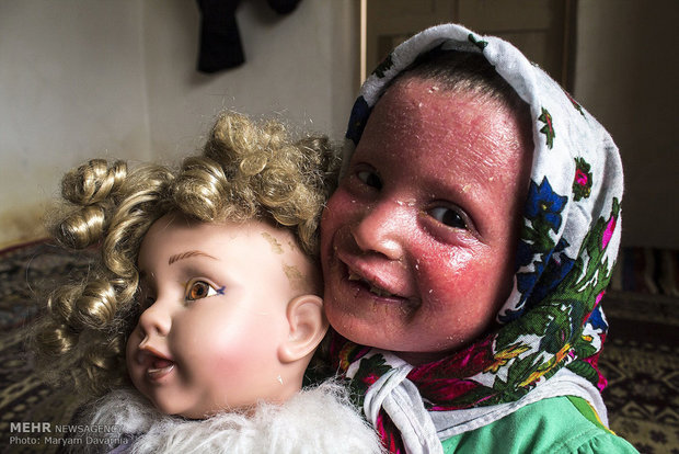 کودک ۶ ساله با بیمار نادر پوستی به «خوبی از خودتونه» میآید بیماری پوستی نرگس رسولی