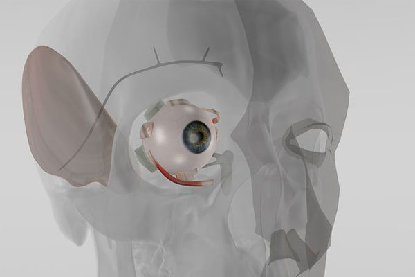 کاشت ریزپمپ در چشم برای تنظیم مایعات سیستم بینایی