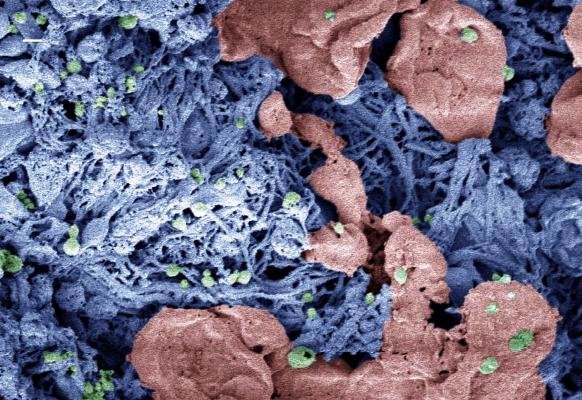 بند آوردن سریع خونریزیهای داخلی با نانو ذرات خونریزی داخلی