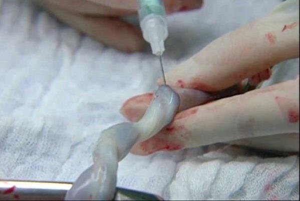 بانک بند ناف