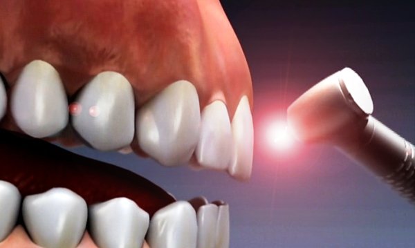 بهبود سازش پذیری ایمپلنت های دندانی با سلول های بنیادی