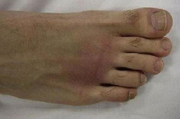 علائم آرتروز پا را بشناسید