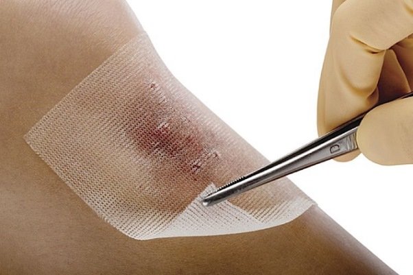 زخم‌ پوش‌های نانو لیفی برای ترمیم زخم های دیابتی ساخته شد
