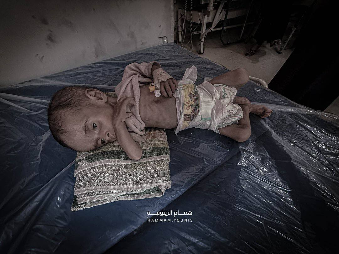مرگ تدریجی نوزاد ۴ ماهه فلسطینی در غزه+ تصاویر