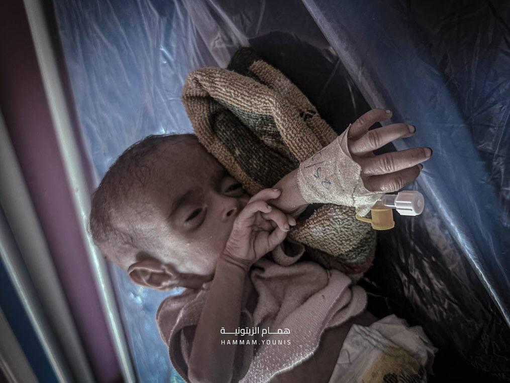 مرگ تدریجی نوزاد ۴ ماهه فلسطینی در غزه+ تصاویر