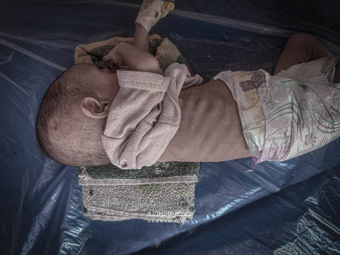 مرگ تدریجی نوزاد ۴ ماهه فلسطینی در غزه+ تصاویر
