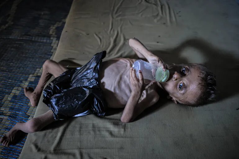 بحران گرسنگی در غزه از دریچه دوربینها؛ مرگ تدریجی کودکان بیگناه