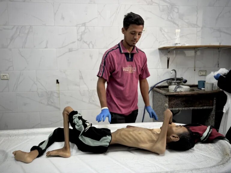 بحران گرسنگی در غزه از دریچه دوربینها؛ مرگ تدریجی کودکان بیگناه