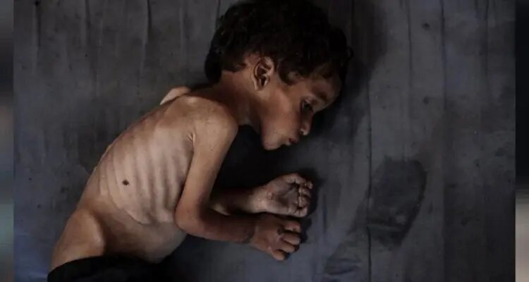 بحران گرسنگی در غزه از دریچه دوربینها؛ مرگ تدریجی کودکان بیگناه