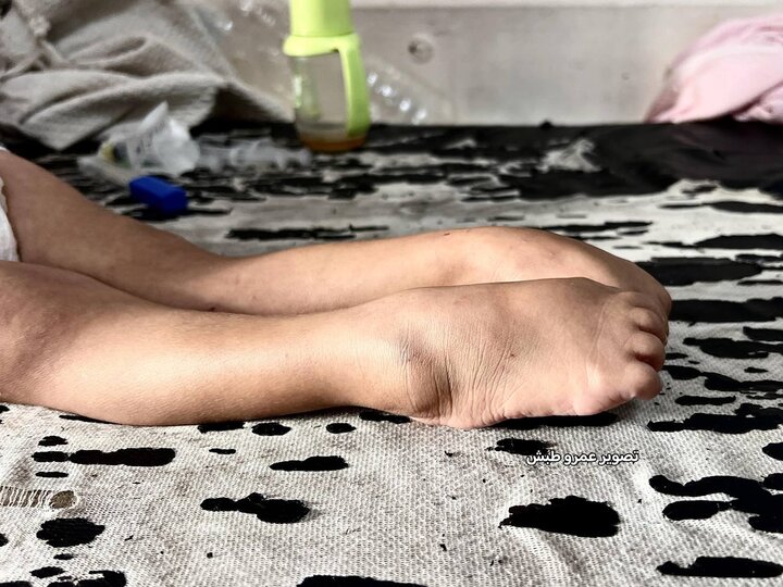 مریم ابو مصطفی؛ روایت تلخ مرگ تدریجی یک کودک در غزه+ تصاویر