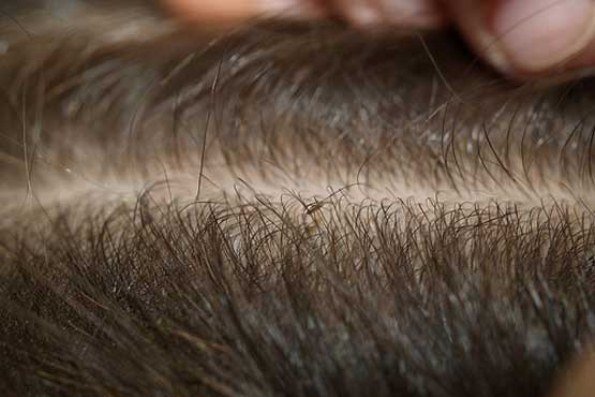 جولان شپش ها در مدارس «بهارستان» 2 پایگاه خبری ججین پایگاه خبر ججین