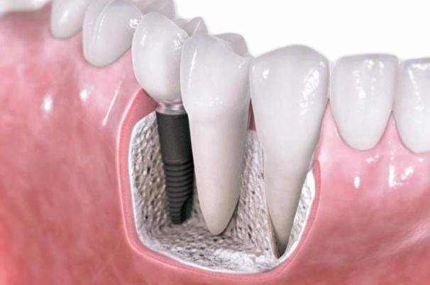 طراحی ایمپلنت دندانی با توجه به ابعاد استخوانی هر فرد