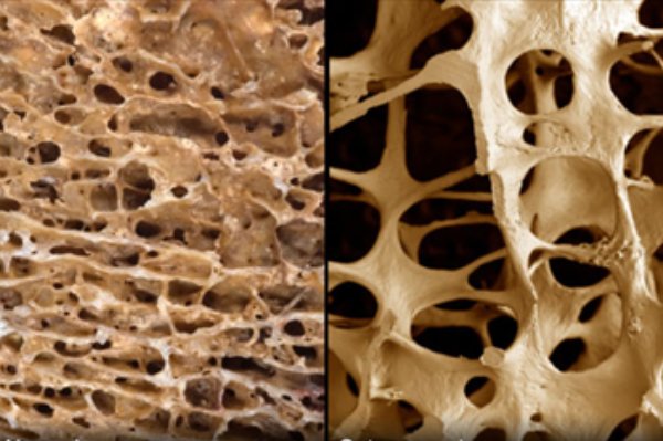 تشخیص زودهنگام بیماری پوکی استخوان از روی تراشه‌های ناخن