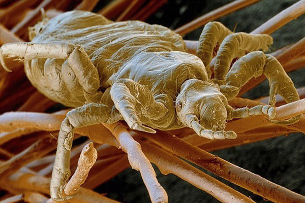 بارانداز شپش در مدارس خراسان شمالی؛ شیوع شپش در بین دختران دانش آموز