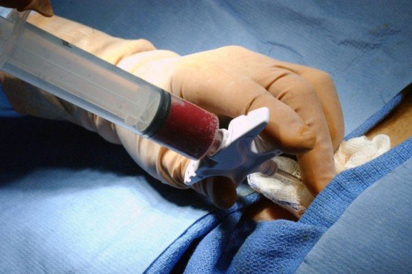 Second autologous transplant for aplastic anemia successful