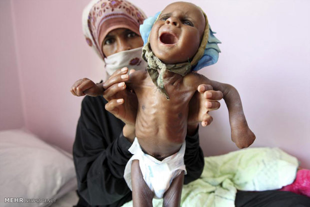 گرسنگی در یمن‎