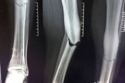 تصویر پای شکسته «دمبا با» منتشر شد/ دوری هشت ماهه از میدان!