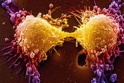 ترکیب نانوذرات و رادیودرمانی برای غلبه بر سرطان