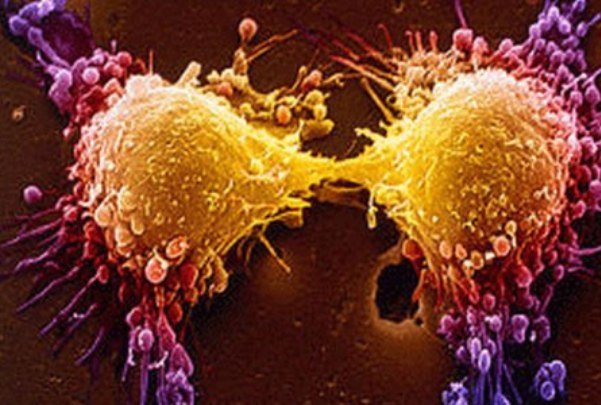 ترکیب نانوذرات و رادیودرمانی برای غلبه بر سرطان