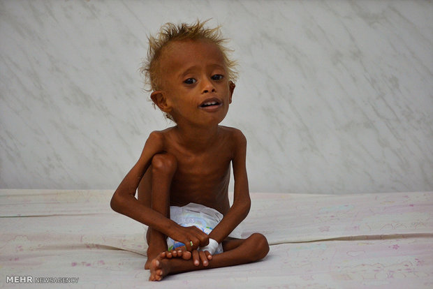 کودکان گرسنه یمنی‎
