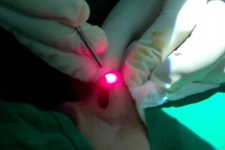 لیزر درمانی غیرمجاز در آرایشگاه‌های بوشهر/مراکزمتخلف پلمب می‌شوند