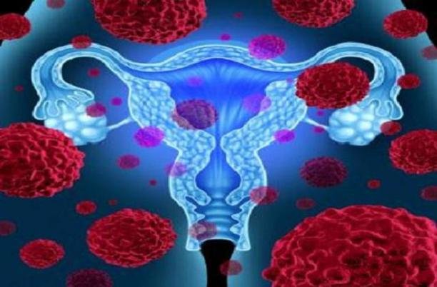 نقش حفاظتی قرص های ضدبارداری در مقابل ابتلا به سرطان تخمدان