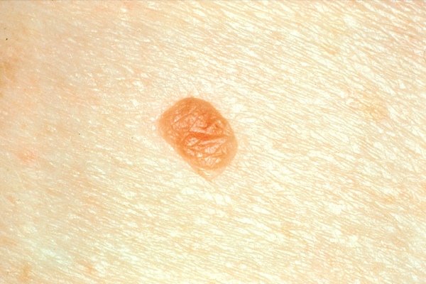 سرطان پوست نشانه خطر ابتلا به سرطان های دیگر است