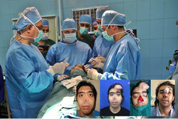 جراحی موفقیت آمیز بازسازی صورت با ساخت اسکلت سه بعدی بینی