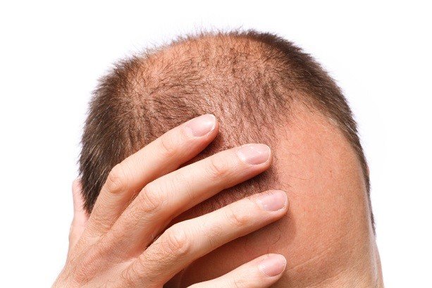 Researchers use stems cells in hair loss treatment