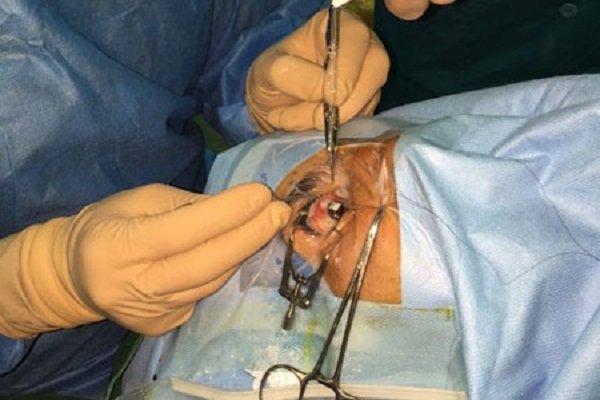 انجام نخستین عمل های جراحی عیوب انکساری چشم در بیمارستان رضوی