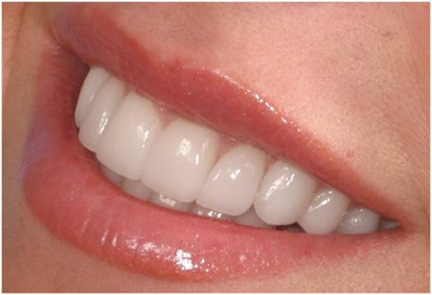 خمیردندانی برای رفع پوسیدگی های سطحی دندان