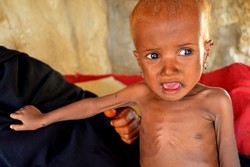 بیش از یک میلیون کودک یمنی از سوء تغذیه رنج می برند