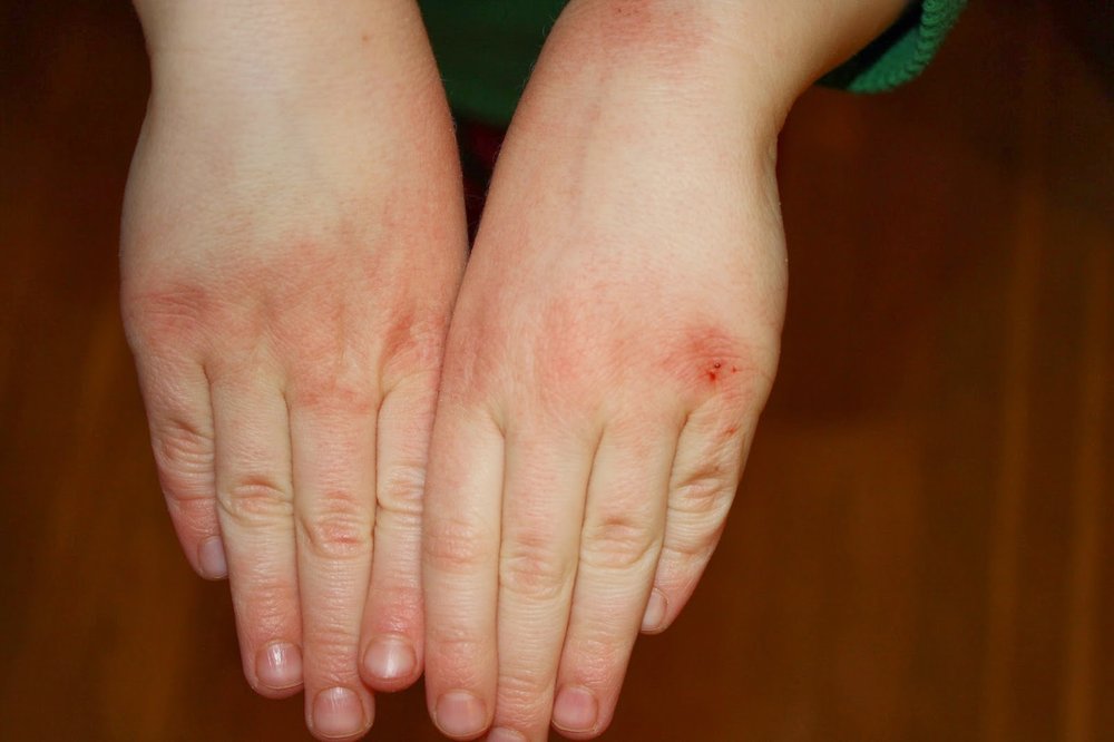 What Does Dry Skin Look Like On Hands