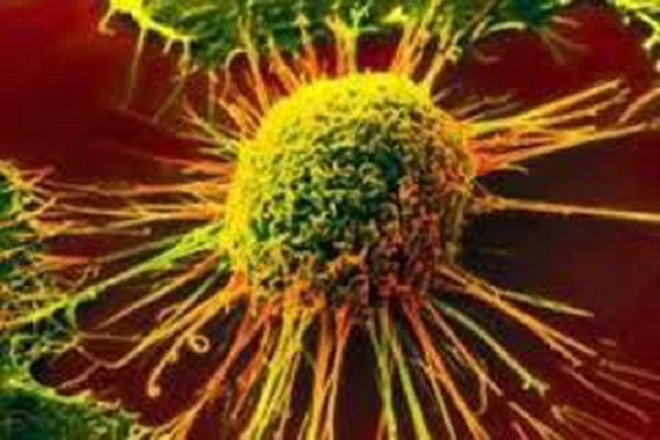 Identifying cancer progression possible with Iranian nanodiogenestic device