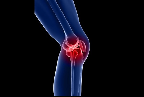 دررفتگی مفصل کشکک  زانو در زنان شایع‌تر از مردان است