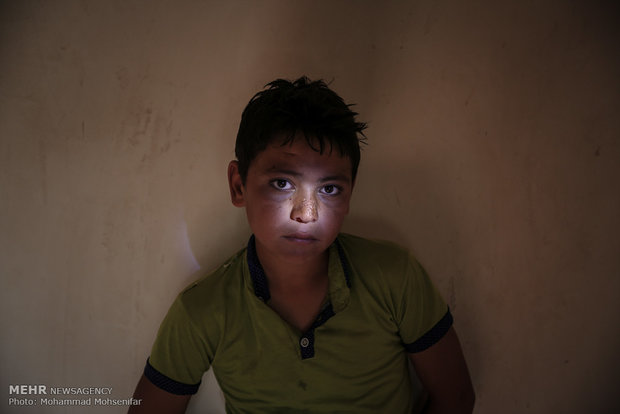 سينا. يازده ساله. از سن دو سالگي مبتلا به بیماری. اهل روستای قره گل كله