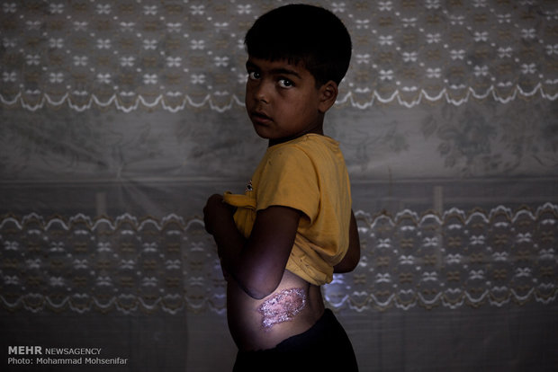 عبدالطیف. نه ساله. از سن نه سالگي مبتلا به بیماری. اهل روستای اینچه برون