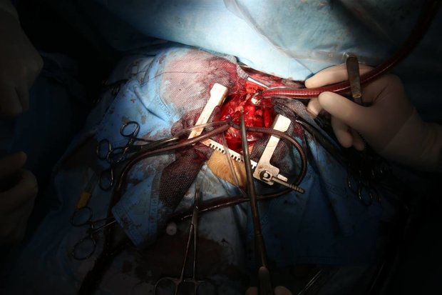 اولین عمل جراحی ترمیم پارگی قلب در دیواندره با موفقیت انجام شد