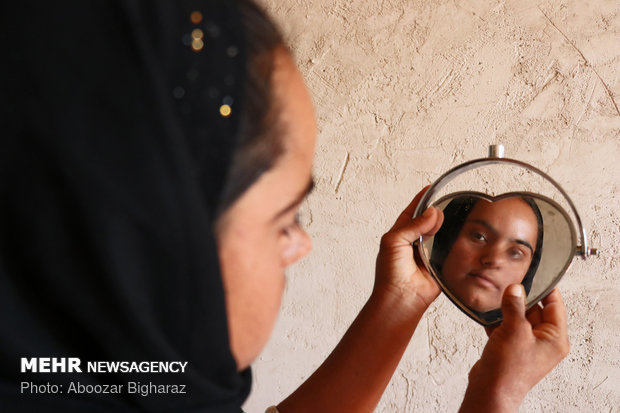 انسیه مبتلا به بیماری سندروم داون