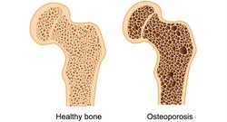 Osteoporosis at alarming level of 30% in Iran