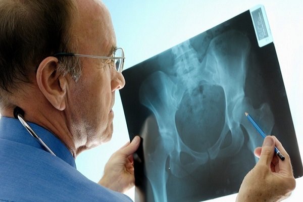 راه‌اندازی کلینیک‌های مدیریت شکستگی برای پیشگیری از پوکی استخوان