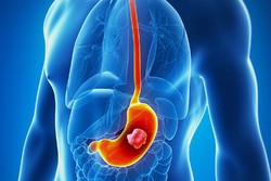 stomach cancer