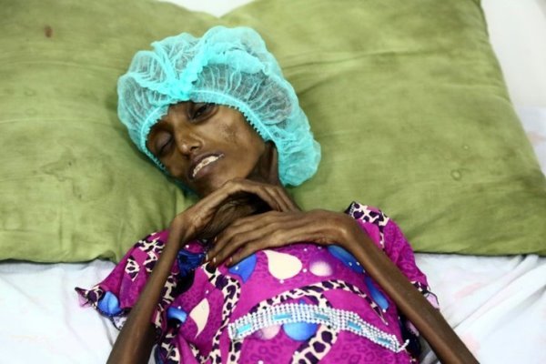 اکثریت زنان باردار در یمن از سوء تغذیه شدید رنج می برند