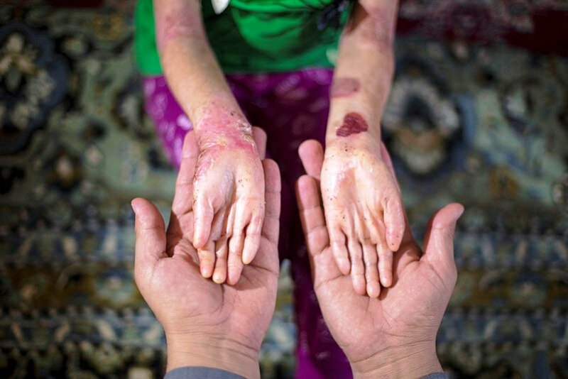 Health Ministry denies shortage of wound dressings for EB patients - Tehran Times