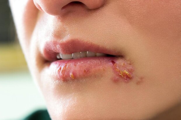 Iranian company produces nanogel to cure herpes, warts