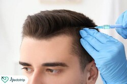 Hair transplant in Iran; Back to the youth