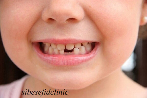 ایمپلنت دندان برای کودکان مبتلا به فقدان مادرزادی دندان