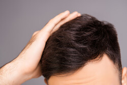 راه های تقویت موهای نازک / مقایسه پی آر پی با مزوتراپی