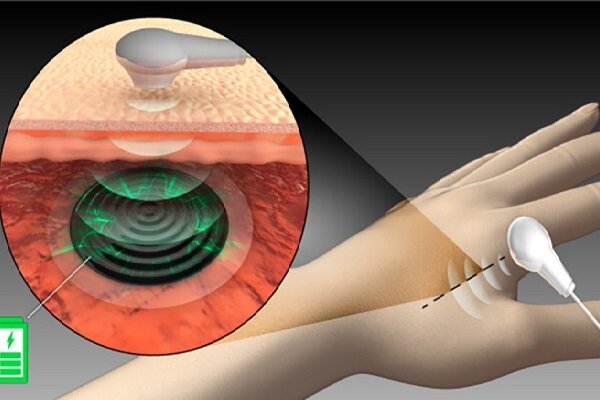 باتری زیستی کاشت ایمپلنت پزشکی را تسهیل می‌کند