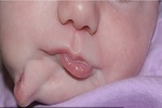 نوزادی با دو دهان متولد شد / جراحی موفقیت آمیز دهان اضافه